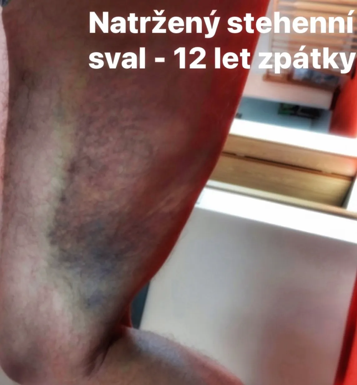 Úrazy stehna. Jak jim předcházet a jak je léčit